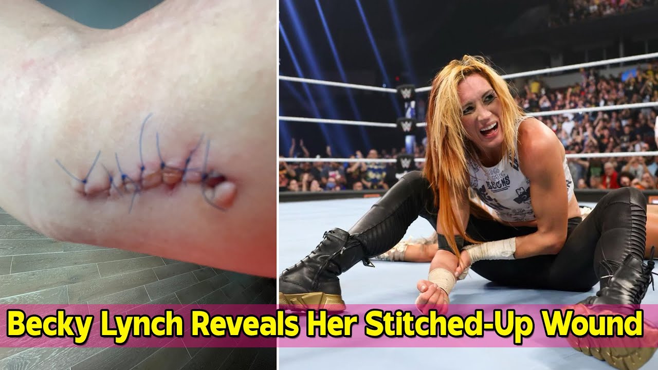 Becky Lynch's Stitches: Inside Her NXT No Mercy Battle Wounds