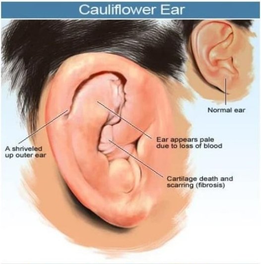 What Causes Dustin Poiriers Ears to Look Different? The Truth Behind Cauliflower Ear