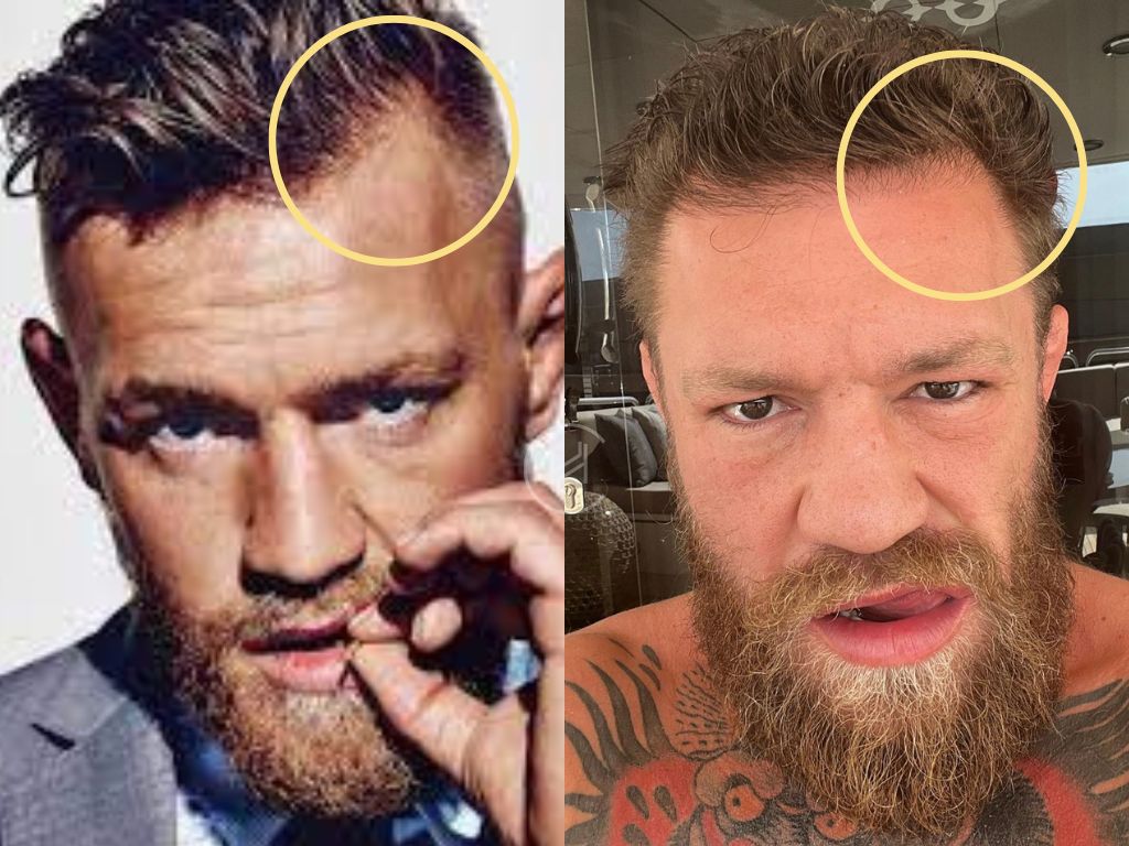 Did Conor McGregor Undergo a Hair Transplant? Exploring His Changing Hairline