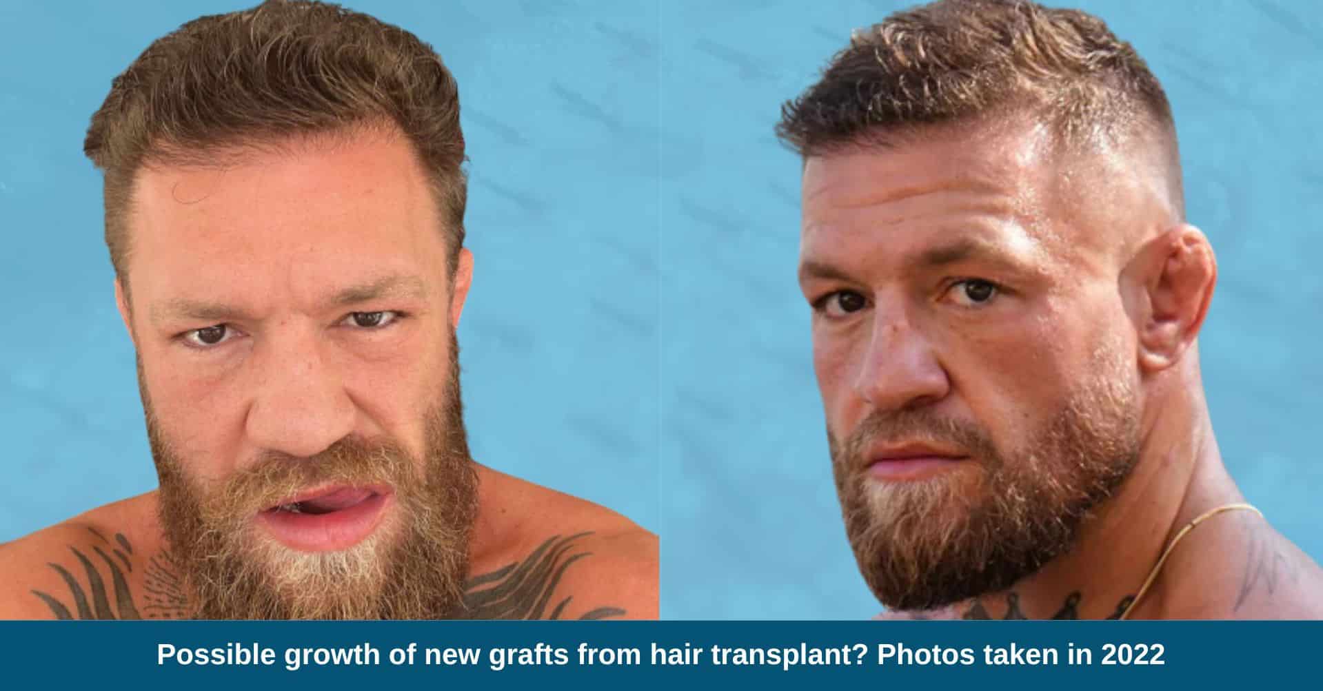 Did Conor McGregor Undergo a Hair Transplant? Exploring His Changing Hairline