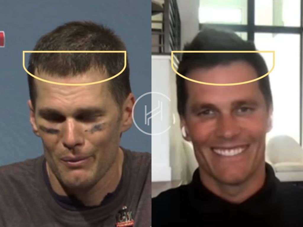 Exploring Tom Bradys Hair Plugs: The Real Story Behind His Transformation