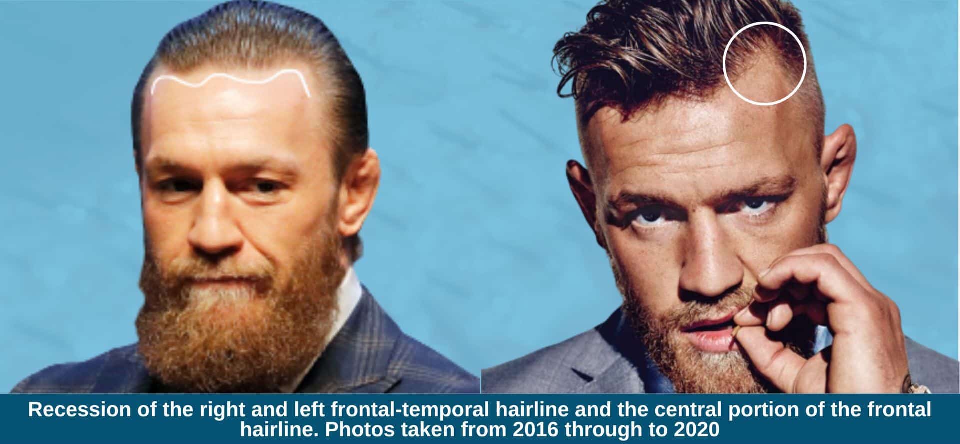 Did Conor McGregor Undergo a Hair Transplant? Exploring His Changing Hairline