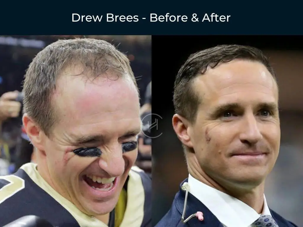 drew brees hair transplant