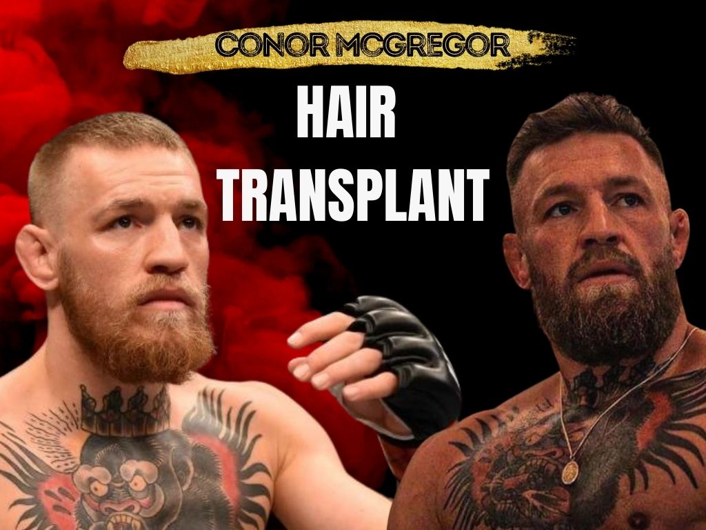 Connor McGregor Balding: Real or Just a Bad Haircut?