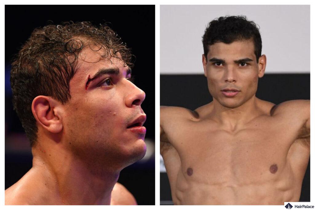 Is Paulo Costa Really Balding? The Truth Behind the Rumors