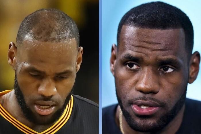 LeBron James Bald: The Truth About His Hairline! (Expert Opinions and Fan Reactions)