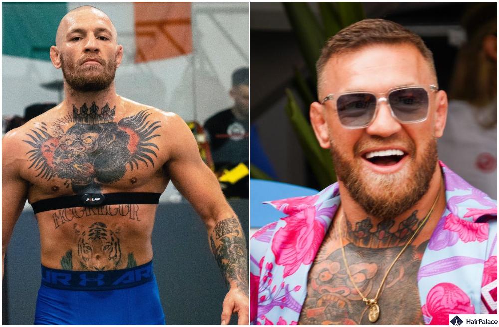 Conor McGregor Hair Transplant: The Truth Behind His New Hairline