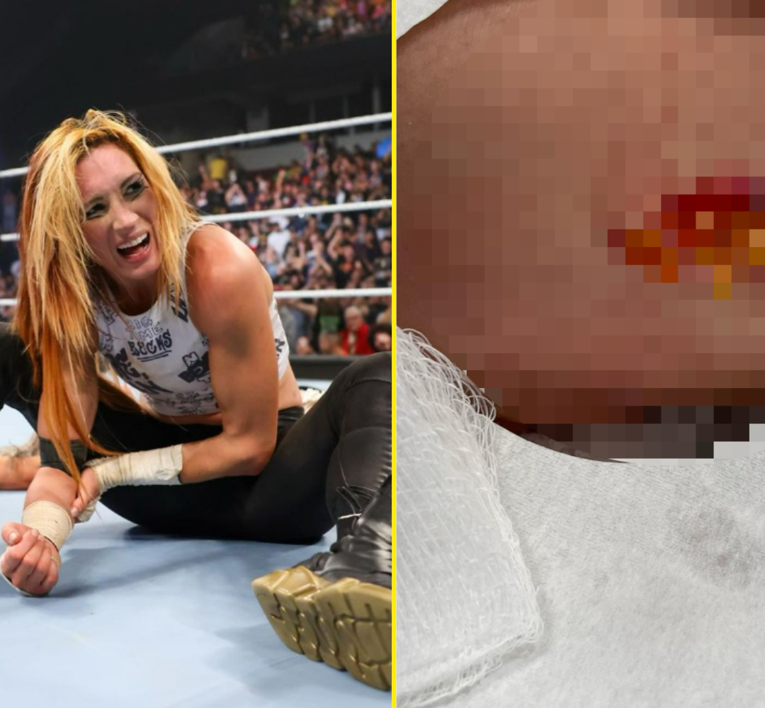 Becky Lynch Elbow: Is She Really Hurt? Get the Latest Details Here