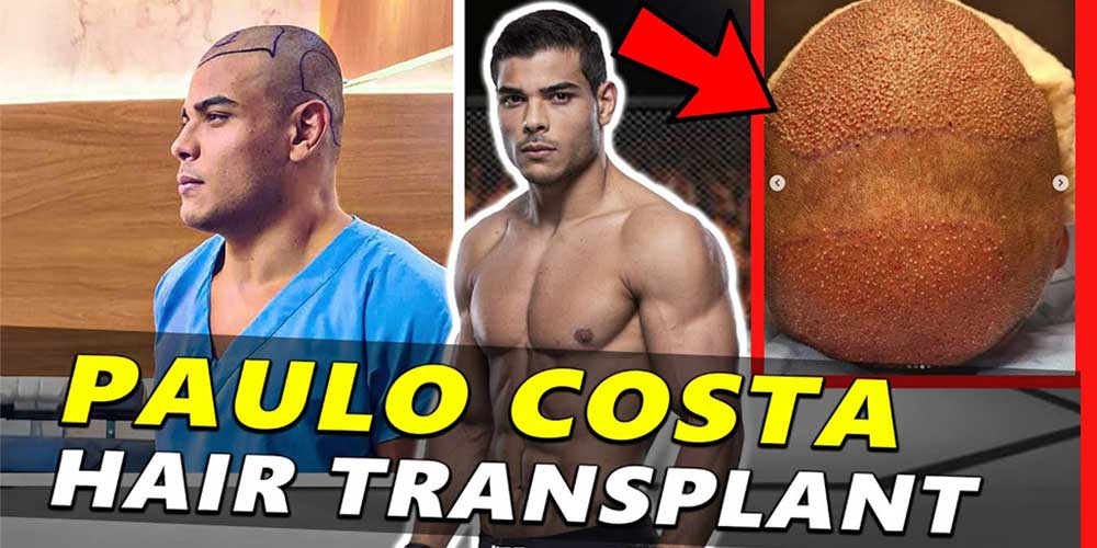 paulo.costa hair transplant:  Everything you want to know is right here!